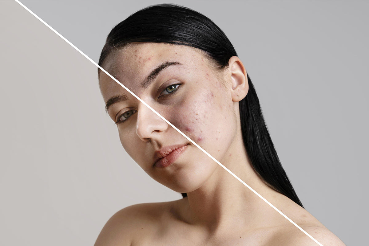 Zamenjala sem izdelke za nego in izpustili so se mi mozolji! Kaj to pomeni?