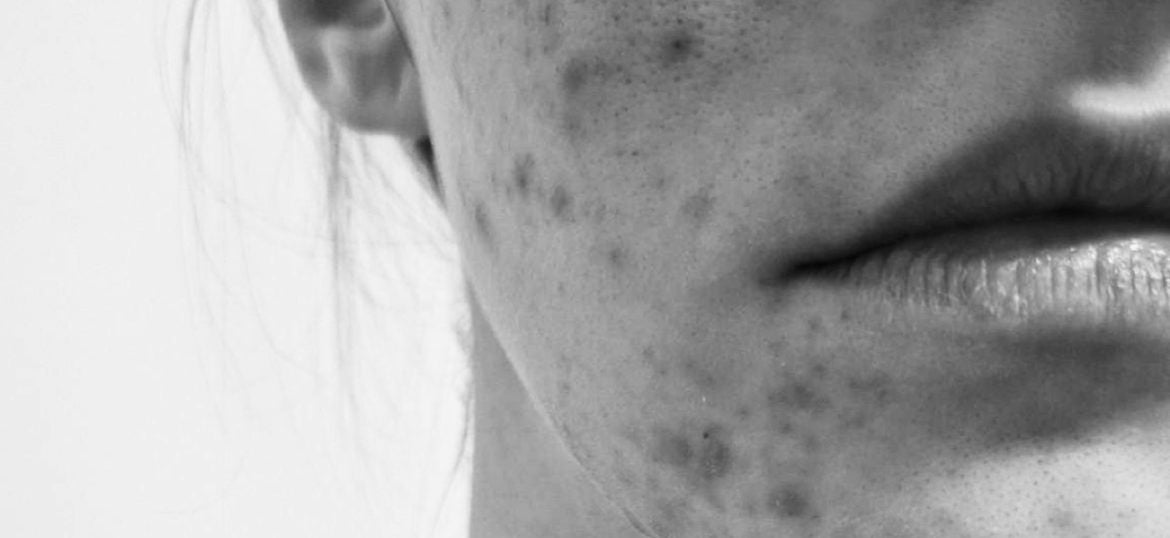 Od aken do čiste kože